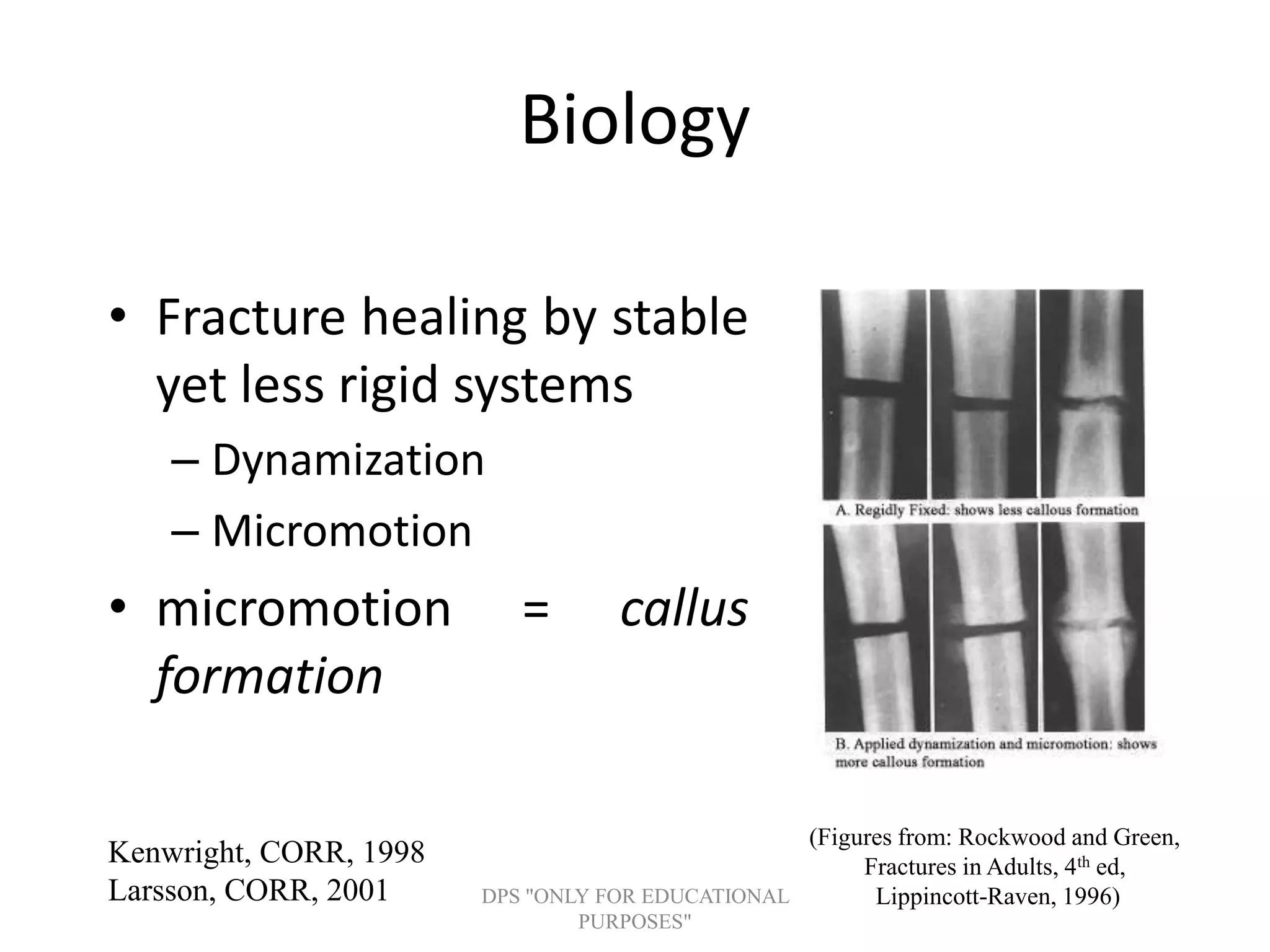 Biology
• Fracture healing by stable
yet less rigid systems
– Dynamization
– Micromotion
• micromotion = callus
formation
(Figures from: Rockwood and Green,
Fractures in Adults, 4th ed,
Lippincott-Raven, 1996)
Kenwright, CORR, 1998
Larsson, CORR, 2001 DPS "ONLY FOR EDUCATIONAL
PURPOSES"
 
