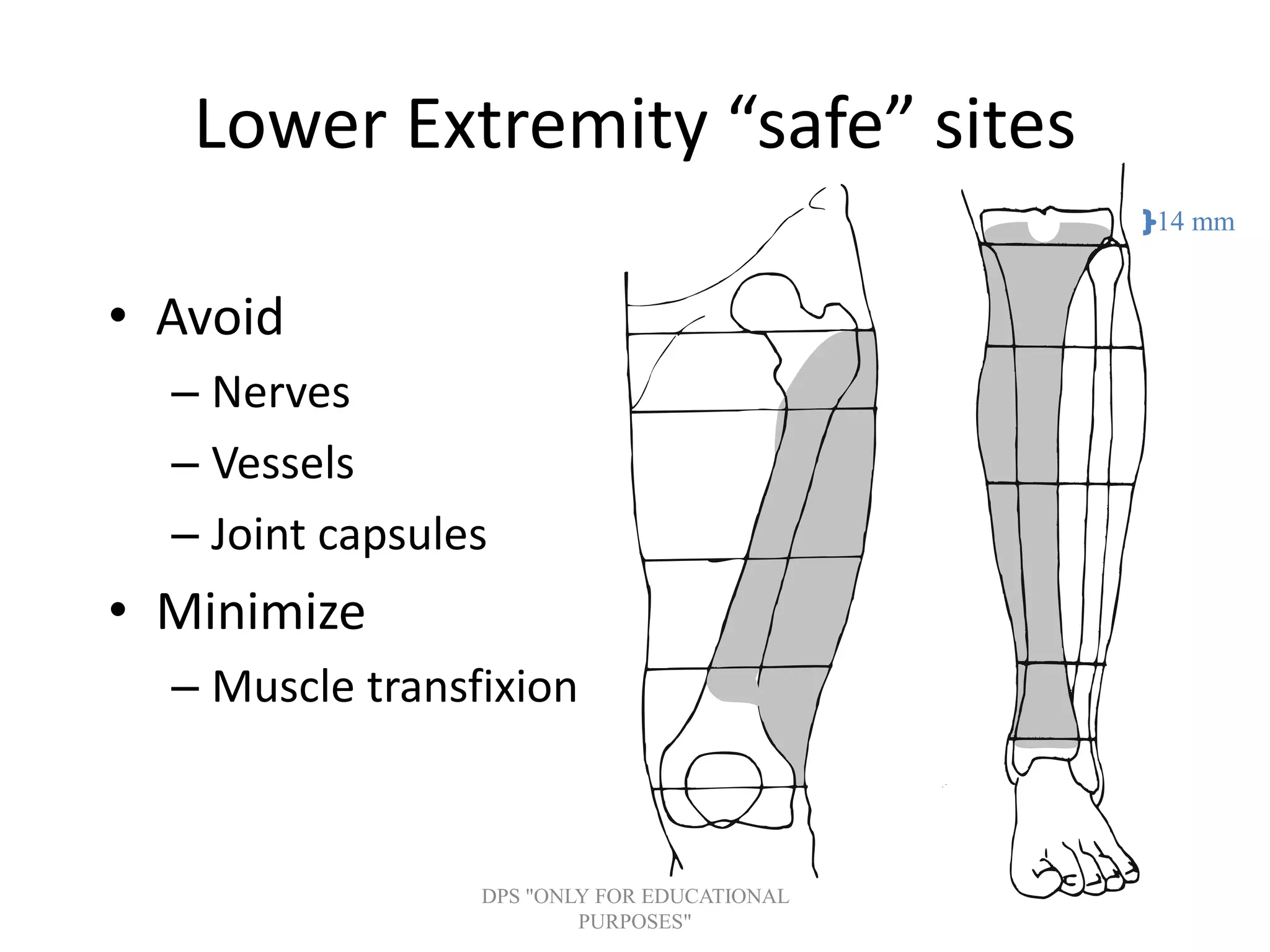 Lower Extremity “safe” sites
• Avoid
– Nerves
– Vessels
– Joint capsules
• Minimize
– Muscle transfixion
14 mm
DPS "ONLY FOR EDUCATIONAL
PURPOSES"
 