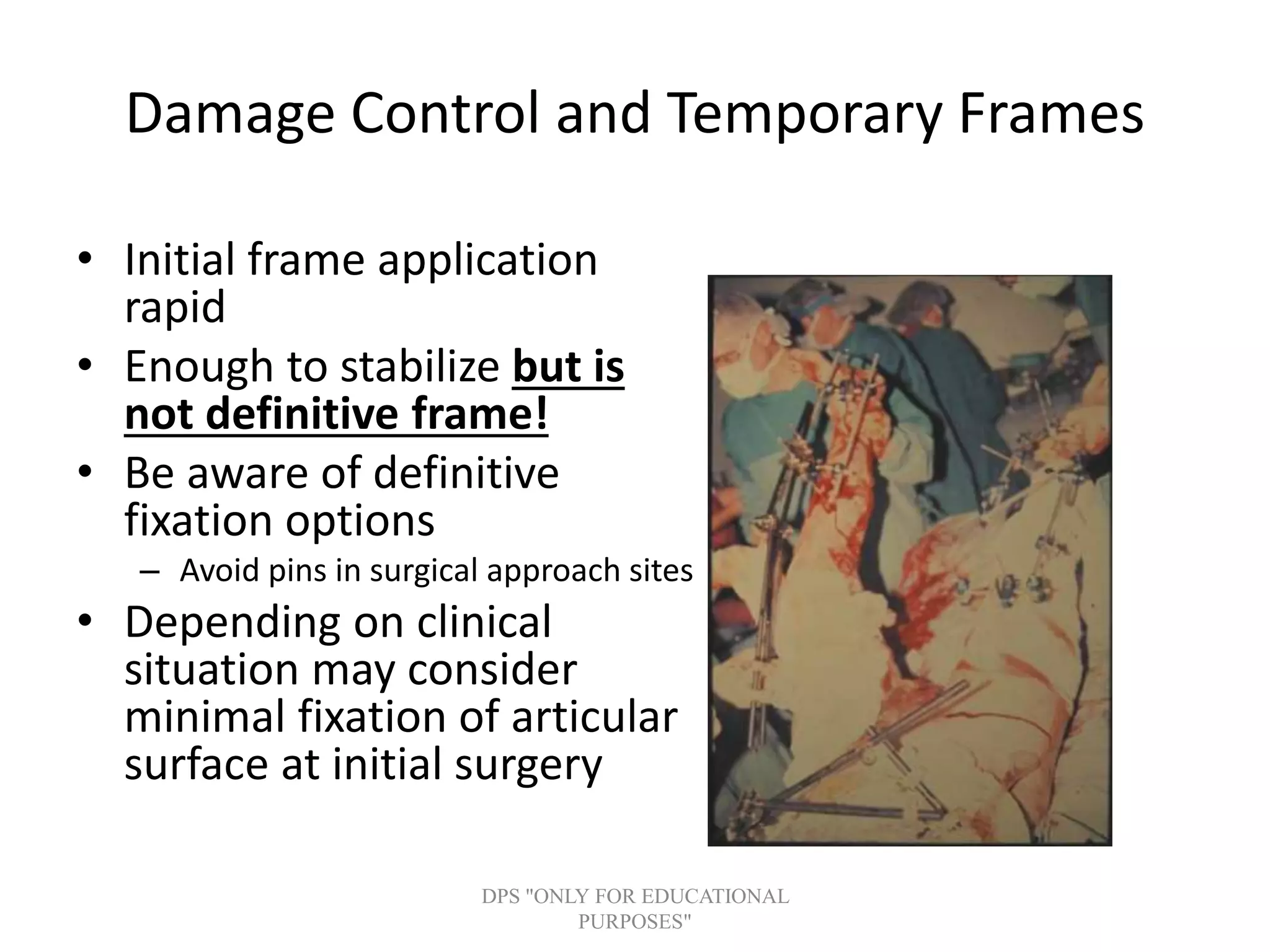 Damage Control and Temporary Frames
• Initial frame application
rapid
• Enough to stabilize but is
not definitive frame!
• Be aware of definitive
fixation options
– Avoid pins in surgical approach sites
• Depending on clinical
situation may consider
minimal fixation of articular
surface at initial surgery
DPS "ONLY FOR EDUCATIONAL
PURPOSES"
 