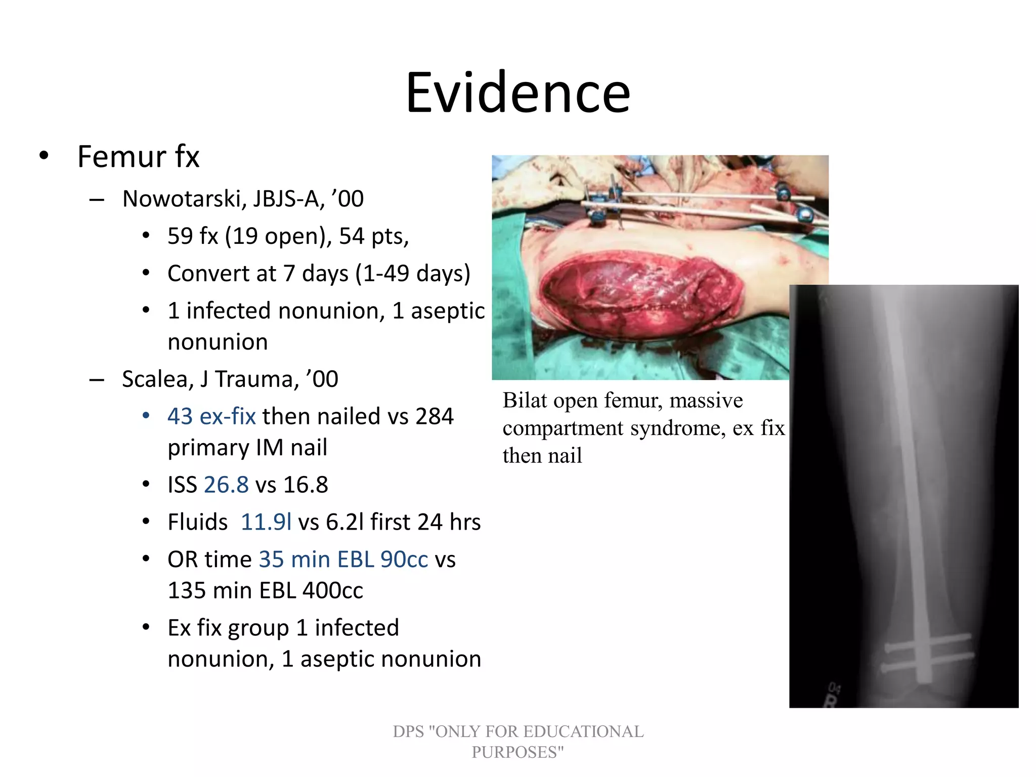 Evidence
• Femur fx
– Nowotarski, JBJS-A, ’00
• 59 fx (19 open), 54 pts,
• Convert at 7 days (1-49 days)
• 1 infected nonunion, 1 aseptic
nonunion
– Scalea, J Trauma, ’00
• 43 ex-fix then nailed vs 284
primary IM nail
• ISS 26.8 vs 16.8
• Fluids 11.9l vs 6.2l first 24 hrs
• OR time 35 min EBL 90cc vs
135 min EBL 400cc
• Ex fix group 1 infected
nonunion, 1 aseptic nonunion
Bilat open femur, massive
compartment syndrome, ex fix
then nail
DPS "ONLY FOR EDUCATIONAL
PURPOSES"
 
