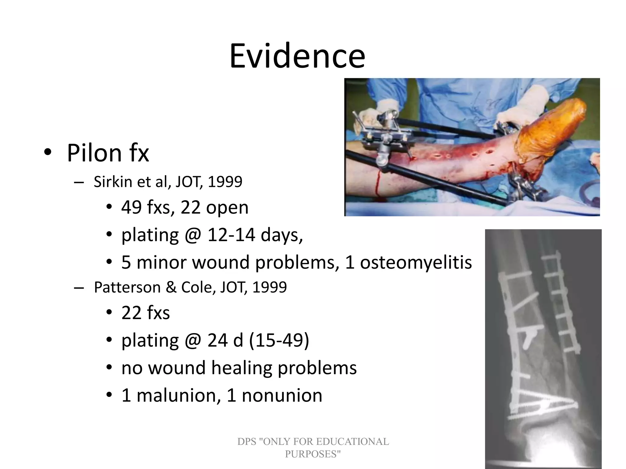 Evidence
• Pilon fx
– Sirkin et al, JOT, 1999
• 49 fxs, 22 open
• plating @ 12-14 days,
• 5 minor wound problems, 1 osteomyelitis
– Patterson & Cole, JOT, 1999
• 22 fxs
• plating @ 24 d (15-49)
• no wound healing problems
• 1 malunion, 1 nonunion
DPS "ONLY FOR EDUCATIONAL
PURPOSES"
 