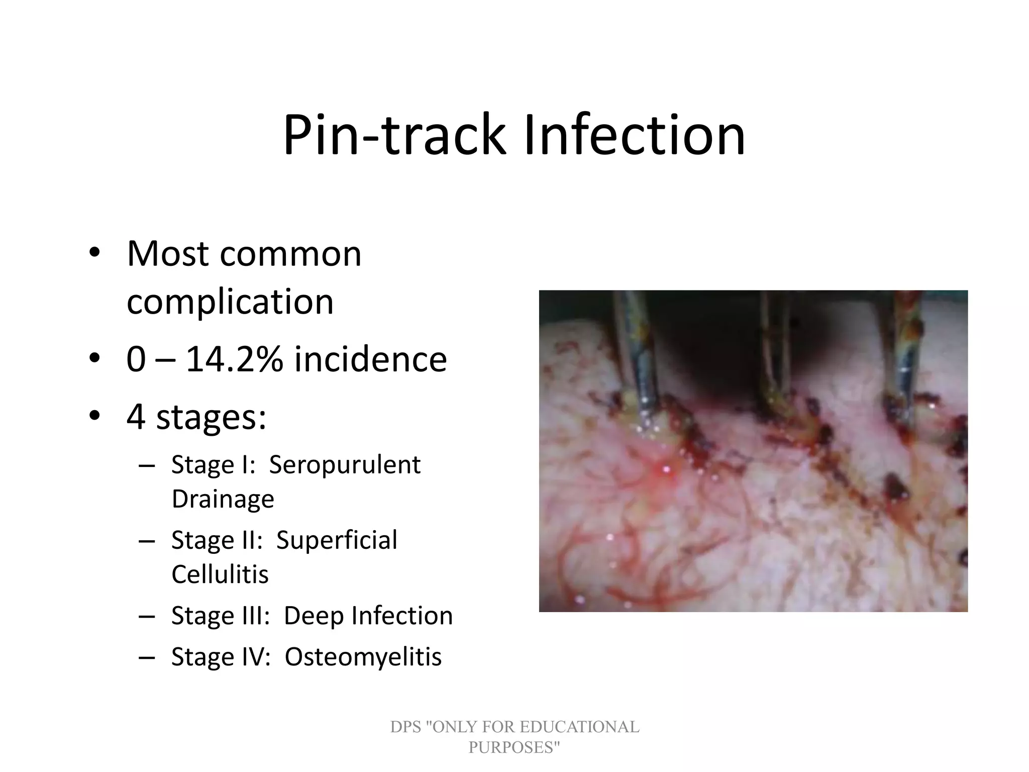 Pin-track Infection
• Most common
complication
• 0 – 14.2% incidence
• 4 stages:
– Stage I: Seropurulent
Drainage
– Stage II: Superficial
Cellulitis
– Stage III: Deep Infection
– Stage IV: Osteomyelitis
DPS "ONLY FOR EDUCATIONAL
PURPOSES"
 