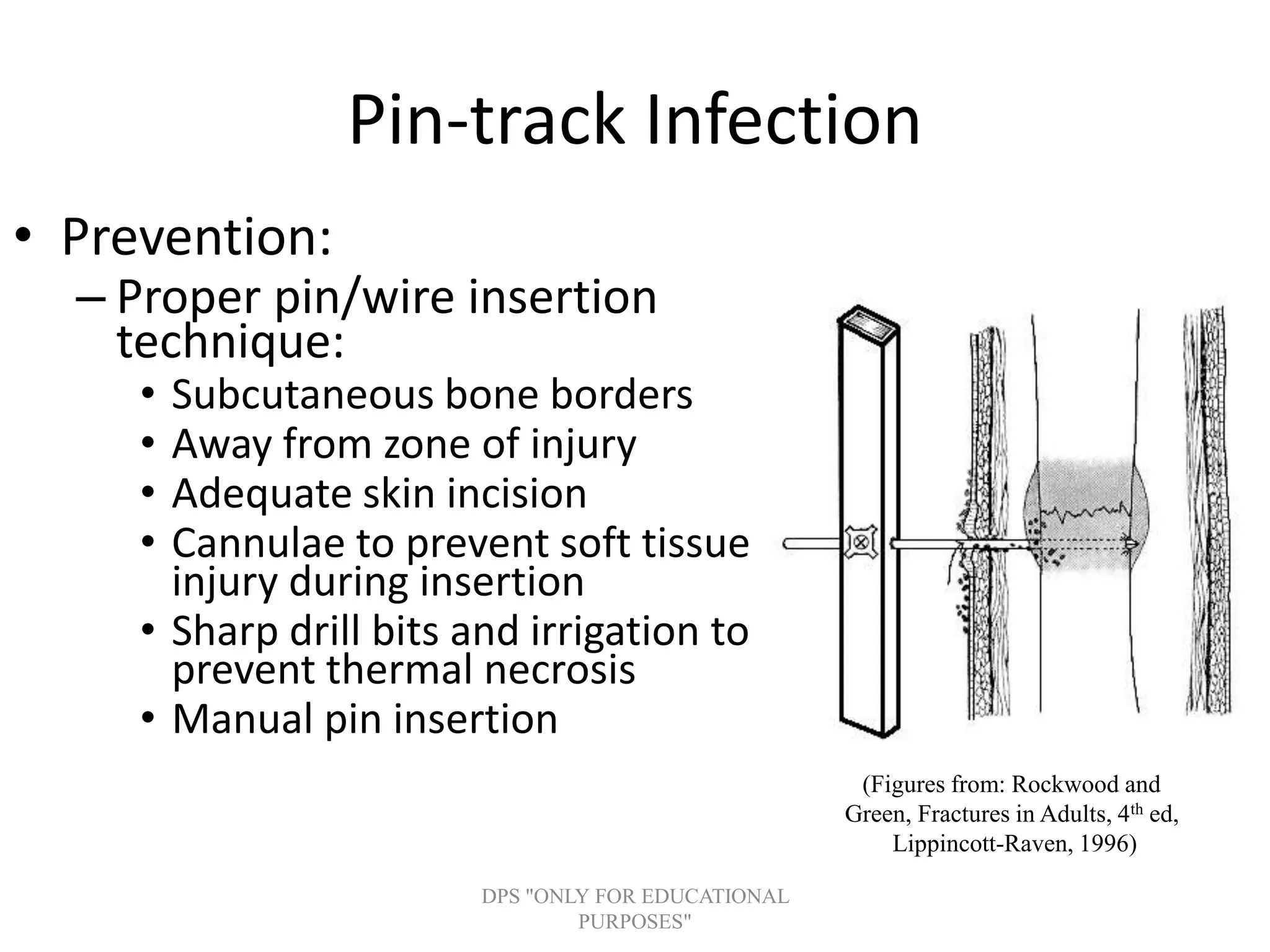 Pin-track Infection
• Prevention:
– Proper pin/wire insertion
technique:
• Subcutaneous bone borders
• Away from zone of injury
• Adequate skin incision
• Cannulae to prevent soft tissue
injury during insertion
• Sharp drill bits and irrigation to
prevent thermal necrosis
• Manual pin insertion
(Figures from: Rockwood and
Green, Fractures in Adults, 4th ed,
Lippincott-Raven, 1996)
DPS "ONLY FOR EDUCATIONAL
PURPOSES"
 