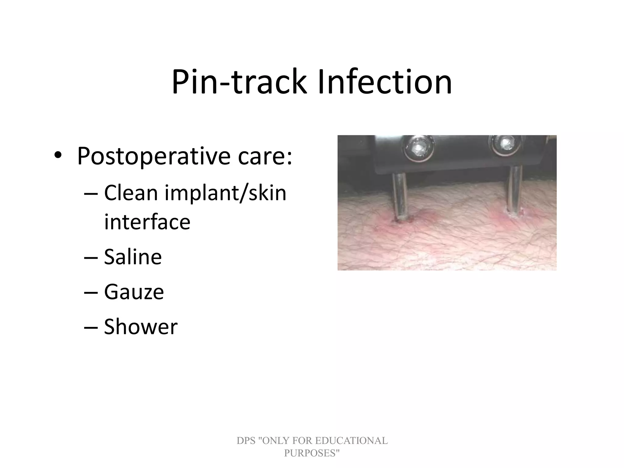 Pin-track Infection
• Postoperative care:
– Clean implant/skin
interface
– Saline
– Gauze
– Shower
DPS "ONLY FOR EDUCATIONAL
PURPOSES"
 