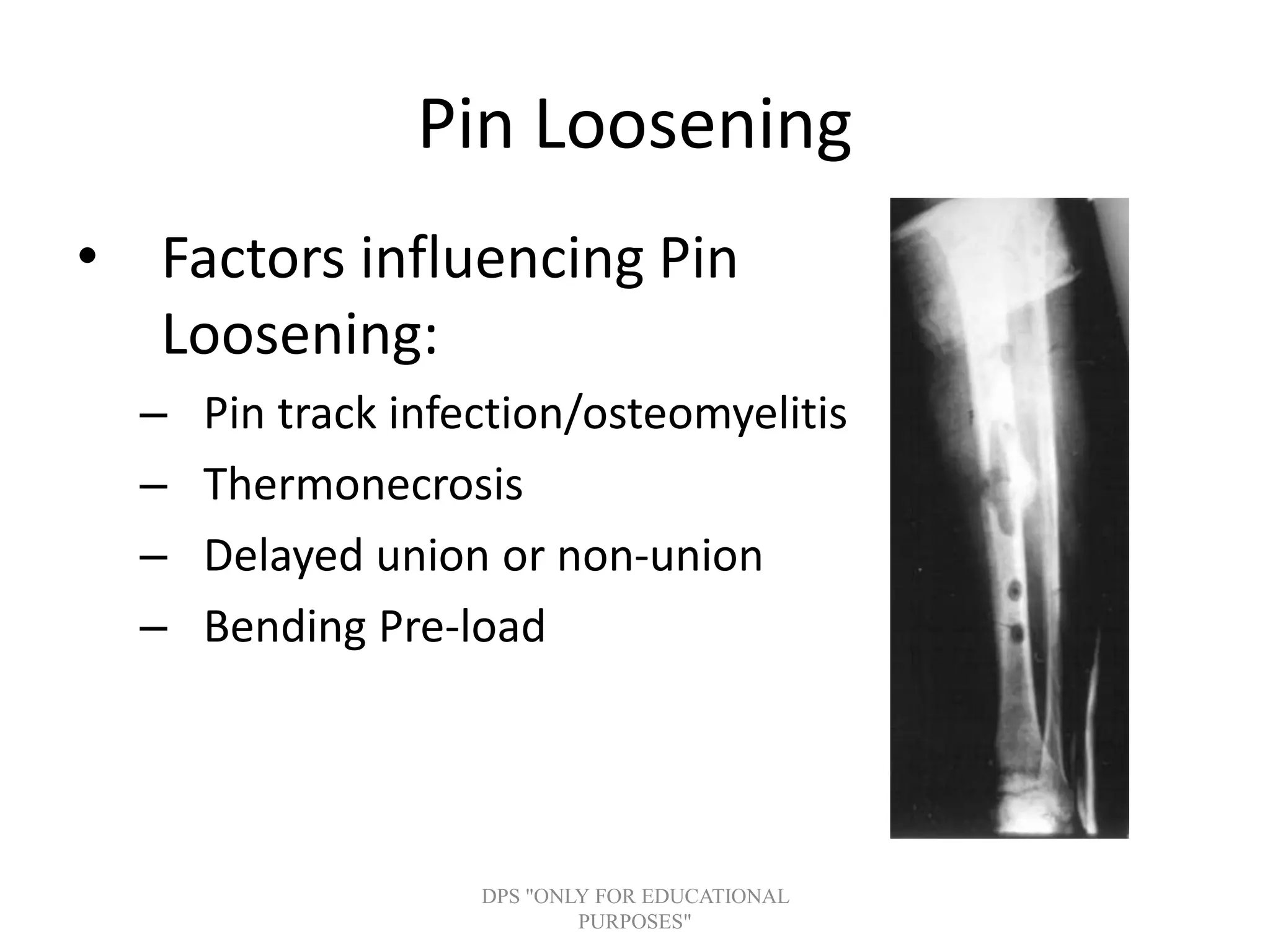 Pin Loosening
• Factors influencing Pin
Loosening:
– Pin track infection/osteomyelitis
– Thermonecrosis
– Delayed union or non-union
– Bending Pre-load
DPS "ONLY FOR EDUCATIONAL
PURPOSES"
 