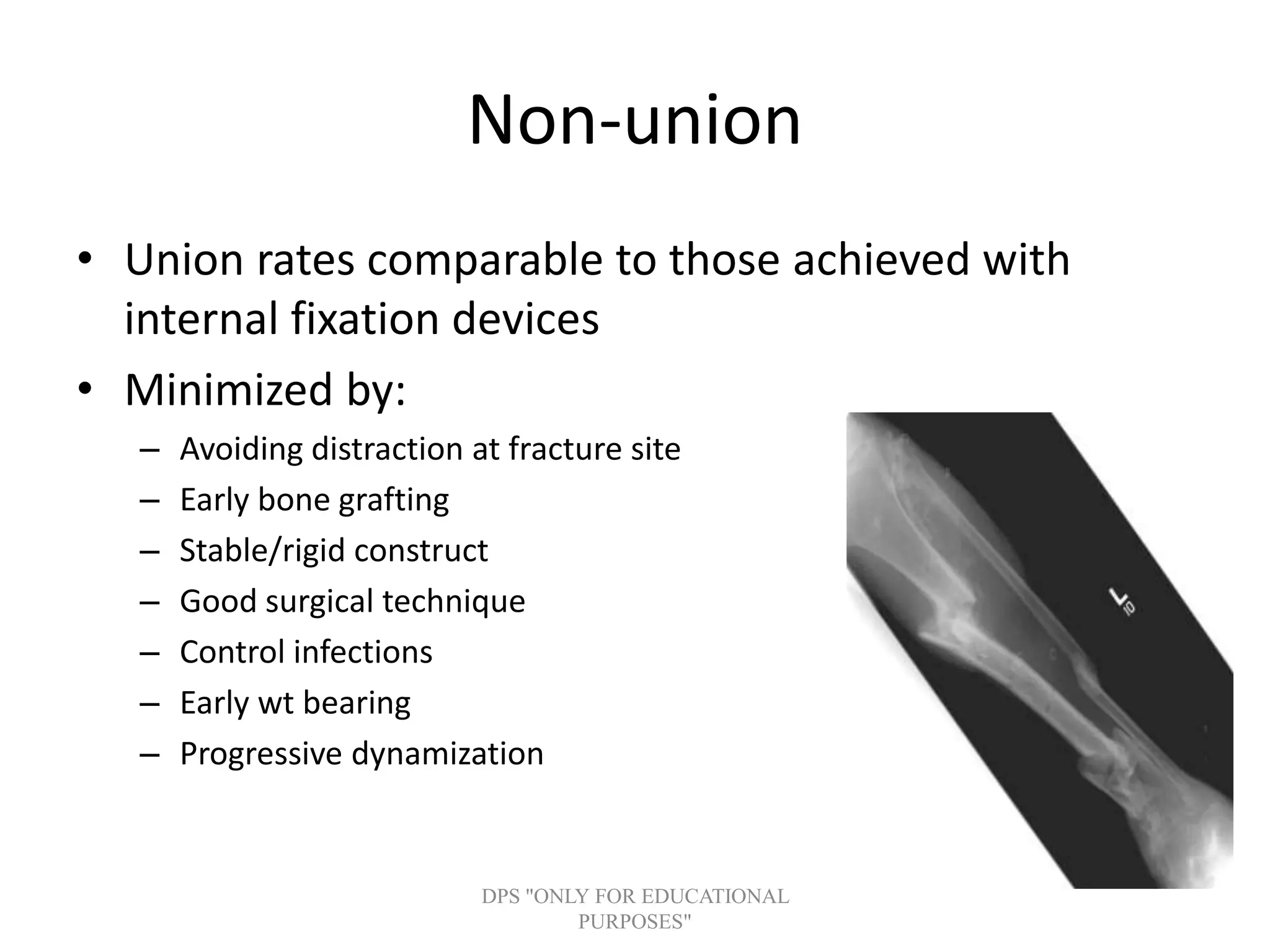 Non-union
• Union rates comparable to those achieved with
internal fixation devices
• Minimized by:
– Avoiding distraction at fracture site
– Early bone grafting
– Stable/rigid construct
– Good surgical technique
– Control infections
– Early wt bearing
– Progressive dynamization
DPS "ONLY FOR EDUCATIONAL
PURPOSES"
 
