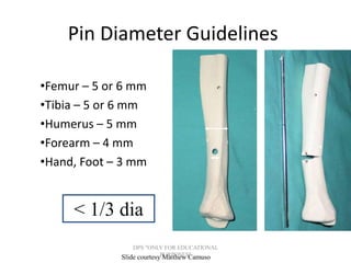 Principles External Fixator Principles of external fixator | PPT