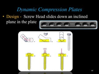 Principles of fixation and osteosynthesis in trauma | PPT