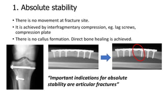 Principles of fracture fixation | PPTX