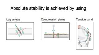 Principles of fracture fixation | PPTX
