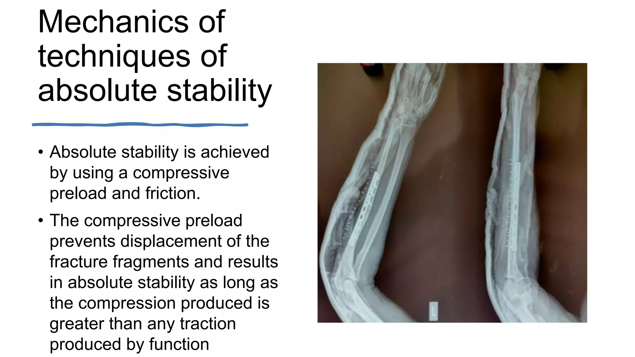 Principles of fracture healing | PPTX