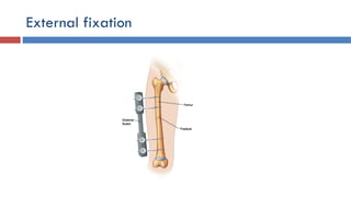 Principles of Fracture Management orthopedics | PPT