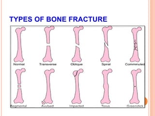 GREENSTICK FRACTURES 
 Bending mechanism 
 Failure on tension side 
 Incomplete fracture, 
plastic deformation on 
comp...