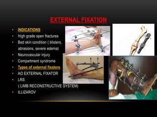 Principles External Fixator Principles of fracture managemnet | PPTX