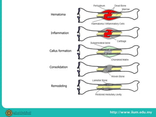 Hematoma
Callus formation
Consolidation
Remodeling
Inflammation
 