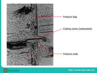 Cutting cones (osteoclasts)
Fracture Gap
Fracture ends
 
