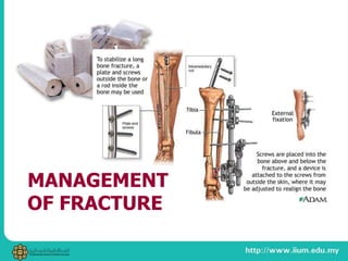 MANAGEMENT
OF FRACTURE
 