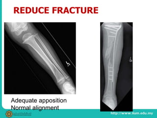 Adequate apposition
Normal alignment
REDUCE FRACTURE
 