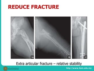REDUCE FRACTURE
Extra articular fracture – relative stability
 
