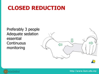 Preferably 3 people
Adequate sedation
essential
Continuous
monitoring
CLOSED REDUCTION
 