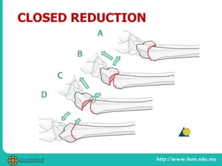 CLOSED REDUCTION
 