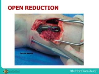 OPEN REDUCTION
 