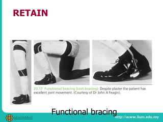 RETAIN
Functional bracing
 