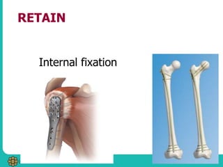 RETAIN
Internal fixation
 