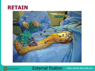 RETAIN
External fixation
 