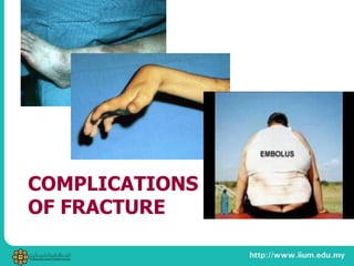 COMPLICATIONS
OF FRACTURE
 