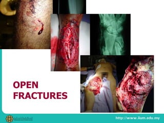 OPEN
FRACTURES
 