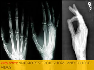 x-ray series: ANTERIO-POSTERIOR, LATERAL AND OBLIQUE
VIEWS

 