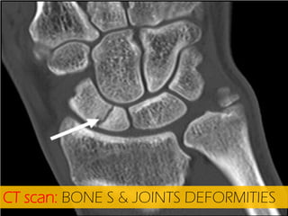 CT scan: BONE S & JOINTS DEFORMITIES

 