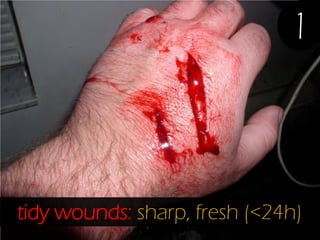 1

tidy wounds: sharp, fresh (<24h)

 