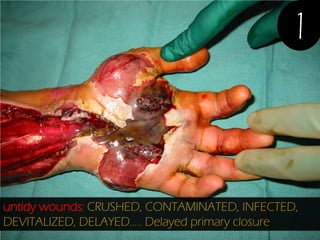 1

untidy wounds: CRUSHED, CONTAMINATED, INFECTED,
DEVITALIZED, DELAYED….. Delayed primary closure

 