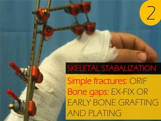 2
SKELETAL STABALIZATION

Simple fractures: ORIF
Bone gaps: EX-FIX OR
EARLY BONE GRAFTING
AND PLATING

 