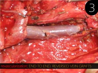 3

revascularization; END TO END, REVERSED VEIN GRAFTS

 