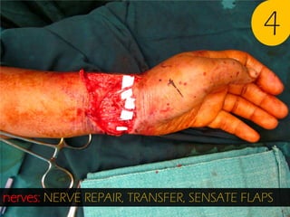 4

nerves: NERVE REPAIR, TRANSFER, SENSATE FLAPS

 