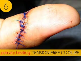 6

primary healing: TENSION FREE CLOSURE

 