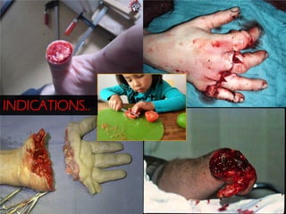 INDICATIONS..

 