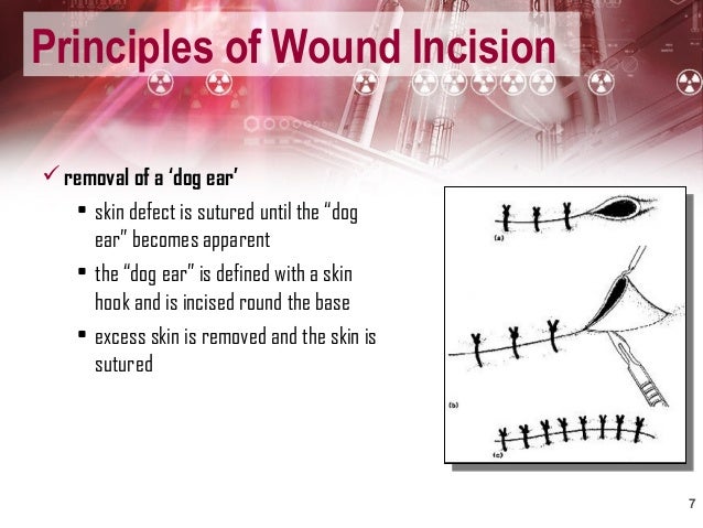 Avoid Dog Ear Suture Avoid Dog Ear Suture