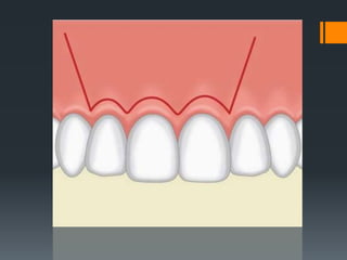 Oval Incision Principles of, incisions in oral surgery.ppt