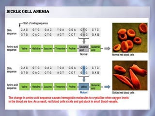 Sickle cell anemia
 