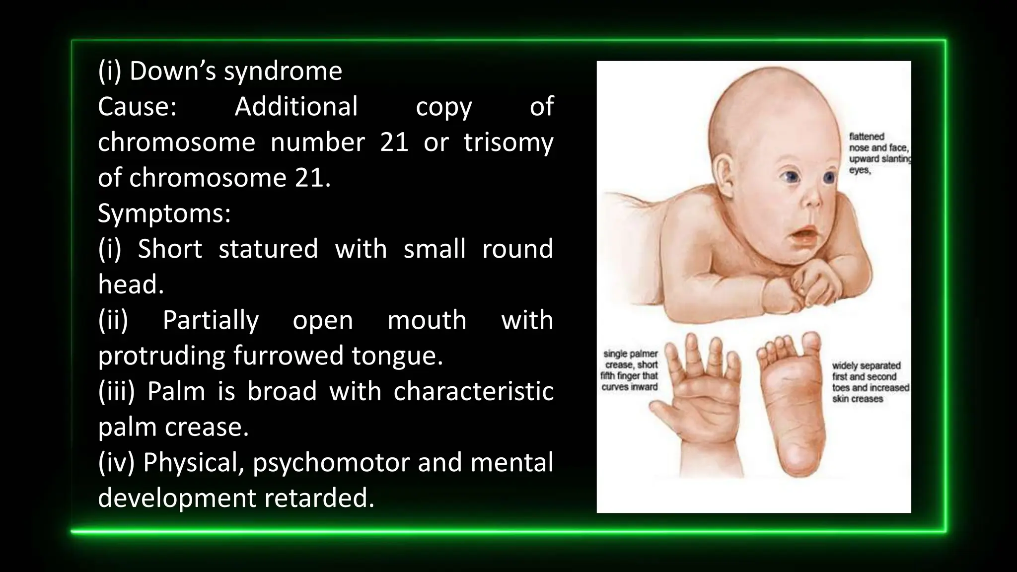 (i) Down’s syndrome
Cause: Additional copy of
chromosome number 21 or trisomy
of chromosome 21.
Symptoms:
(i) Short statured with small round
head.
(ii) Partially open mouth with
protruding furrowed tongue.
(iii) Palm is broad with characteristic
palm crease.
(iv) Physical, psychomotor and mental
development retarded.
 