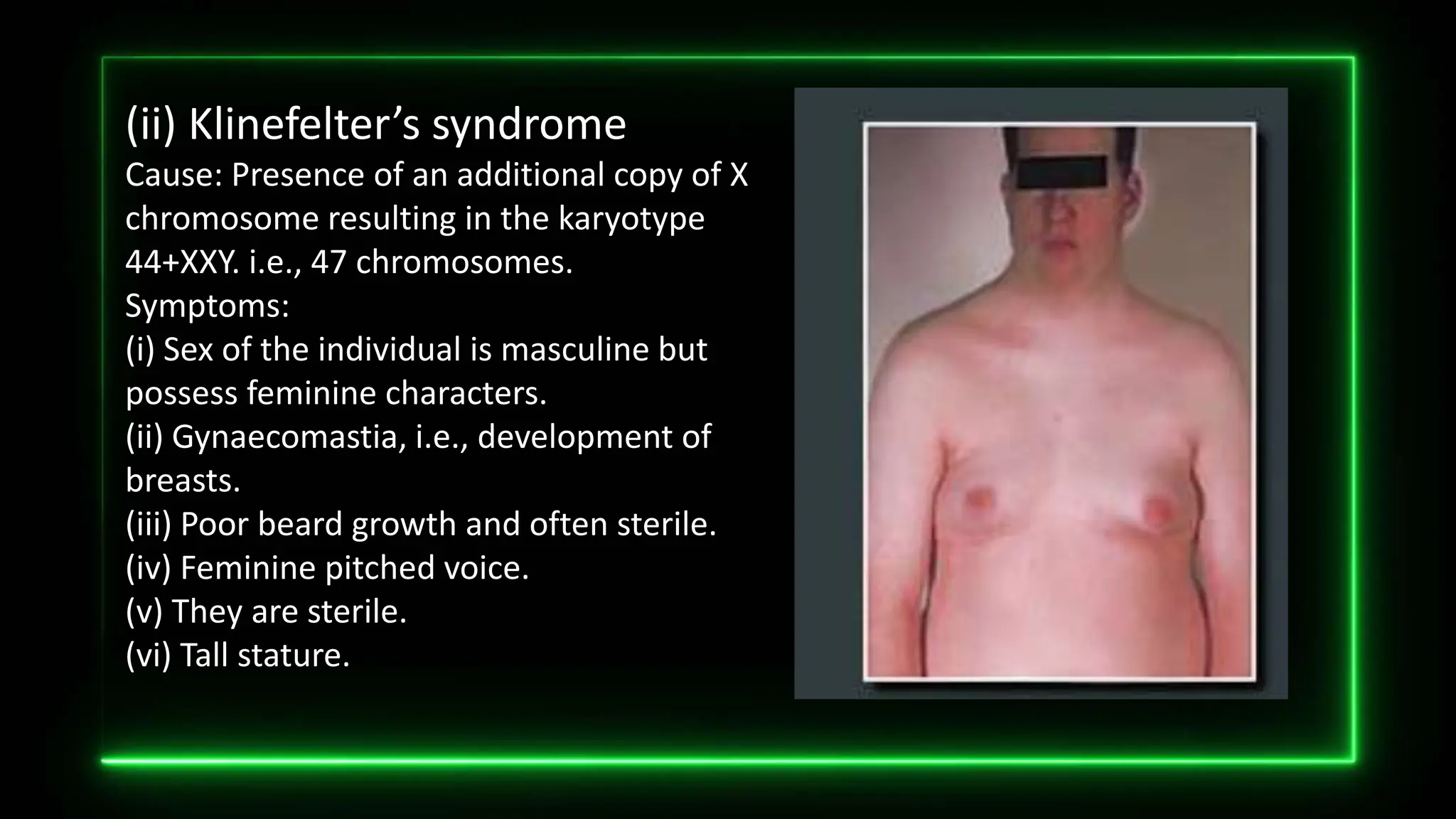 (ii) Klinefelter’s syndrome
Cause: Presence of an additional copy of X
chromosome resulting in the karyotype
44+XXY. i.e., 47 chromosomes.
Symptoms:
(i) Sex of the individual is masculine but
possess feminine characters.
(ii) Gynaecomastia, i.e., development of
breasts.
(iii) Poor beard growth and often sterile.
(iv) Feminine pitched voice.
(v) They are sterile.
(vi) Tall stature.
 
