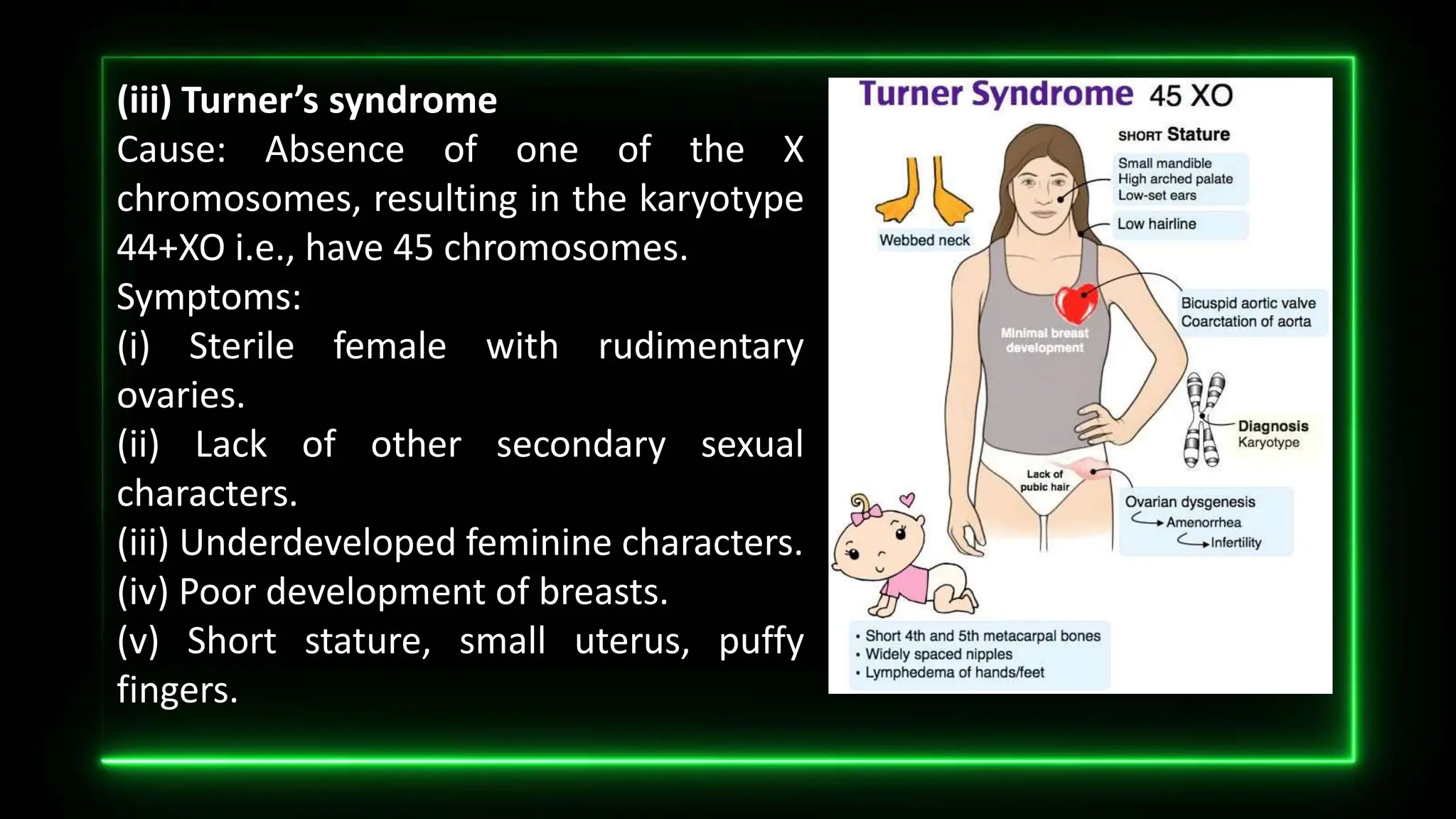 (iii) Turner’s syndrome
Cause: Absence of one of the X
chromosomes, resulting in the karyotype
44+XO i.e., have 45 chromosomes.
Symptoms:
(i) Sterile female with rudimentary
ovaries.
(ii) Lack of other secondary sexual
characters.
(iii) Underdeveloped feminine characters.
(iv) Poor development of breasts.
(v) Short stature, small uterus, puffy
fingers.
 