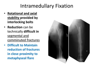 Intramedullary Fixation
• Rotational and axial
stability provided by
interlocking bolts
• Reduction can be
technically difficult in
segmental and
comminuted fractures
• Difficult to Maintain
reduction of fractures
in close proximity to
metaphyseal flare
 