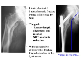 • Intertrochanteric/
Subtrochanteric fracture
treated with closed IM
Nail
• The goal:
• Restore length,
alignment, and
rotation
• NOT anatomic
reduction
• Without extensive
exposure this fracture
formed abundant callus
by 6 weeks
Valgus is restored...
 