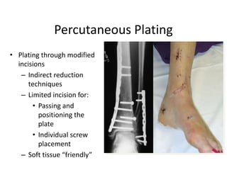 Percutaneous Plating
• Plating through modified
incisions
– Indirect reduction
techniques
– Limited incision for:
• Passing and
positioning the
plate
• Individual screw
placement
– Soft tissue “friendly”
 