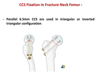 CCS Fixation in Fracture Neck Femur :
- Parallel 6.5mm CCS are used in triangular or inverted
triangular configuration.
 